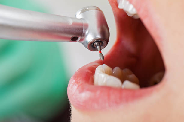 Best Emergency Tooth Extraction in West Springfield, VA